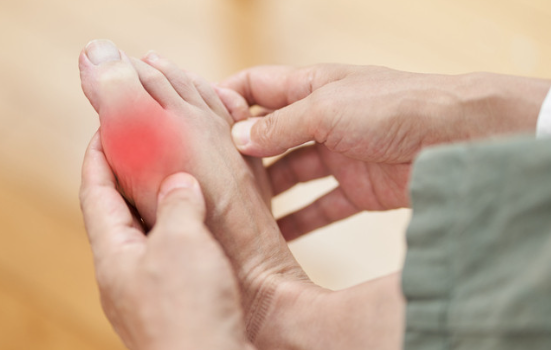 Gout: Symptoms, Treatment & Prevention